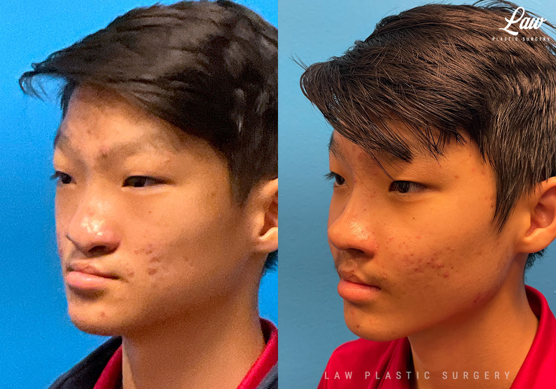 Jaw Distraction Before and After Photo. Surgery performed in Dallas, TX at Law Plastic Surgery.