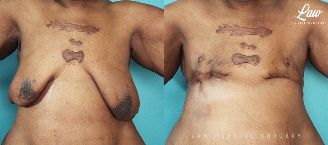 XL Breast Augmentation Dallas Before & After