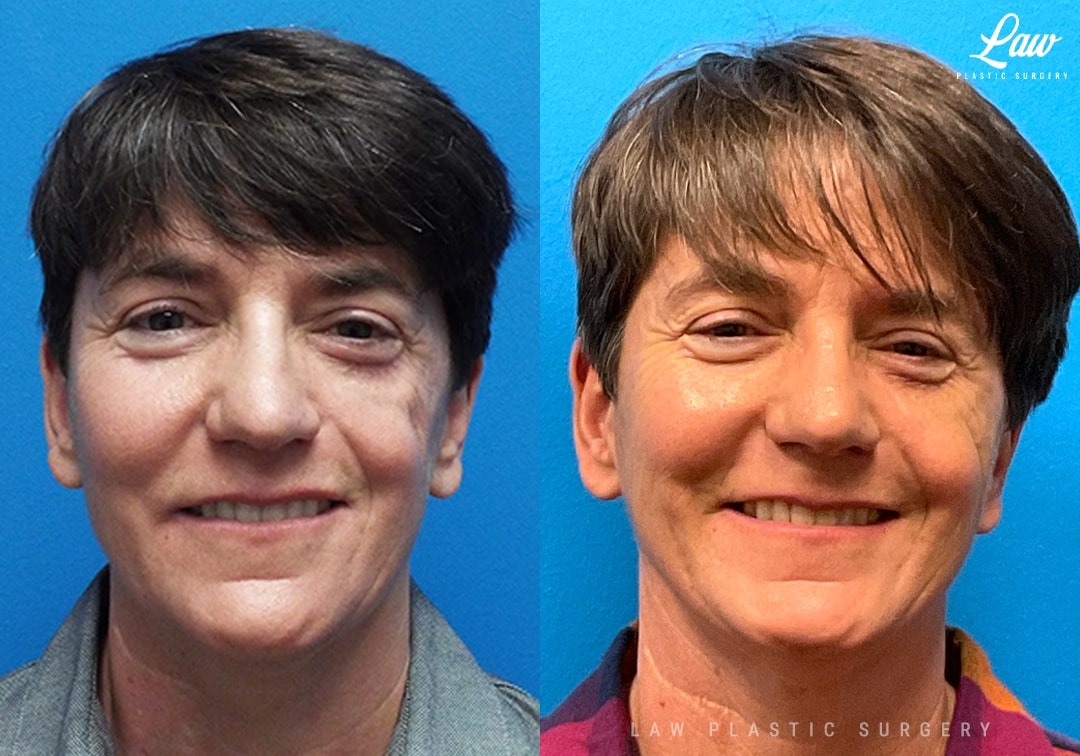 Parry-Romberg Syndrome