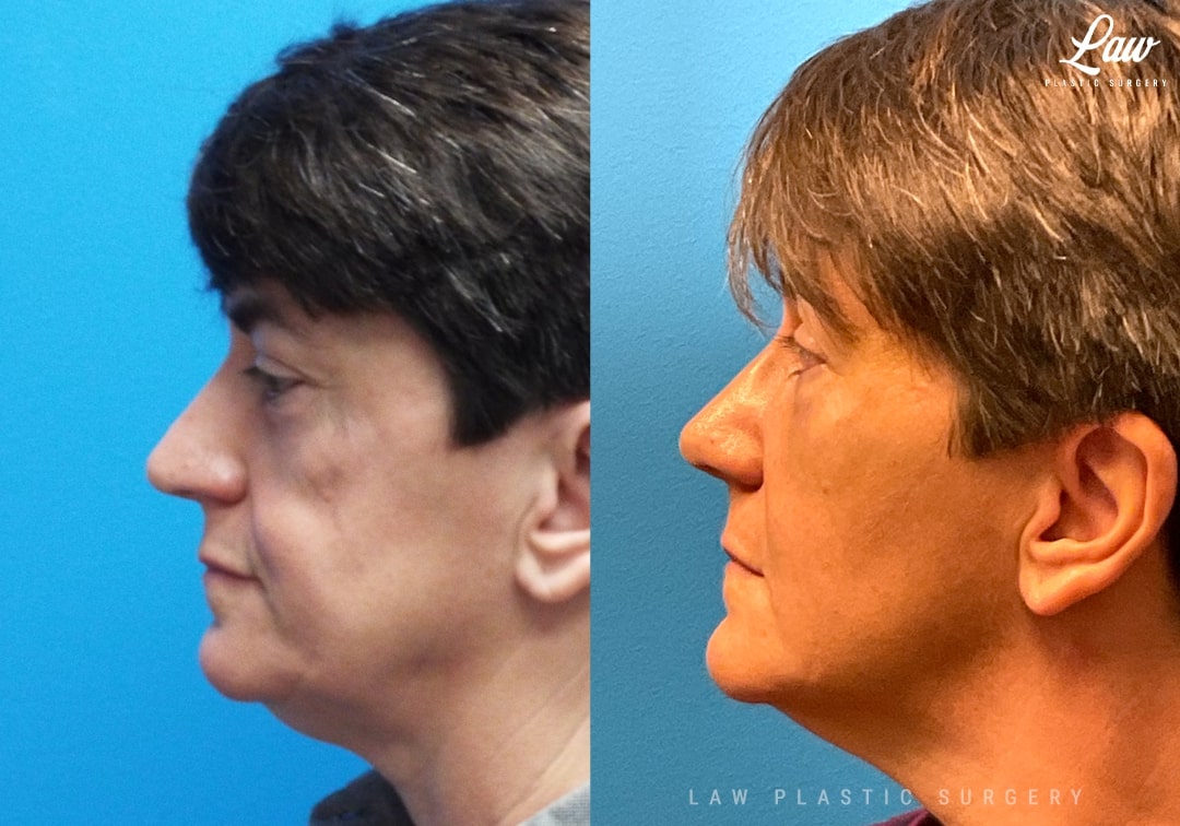 Parry Romberg Syndrome Before and After Photo. Surgery performed in Dallas, TX at Law Plastic Surgery.