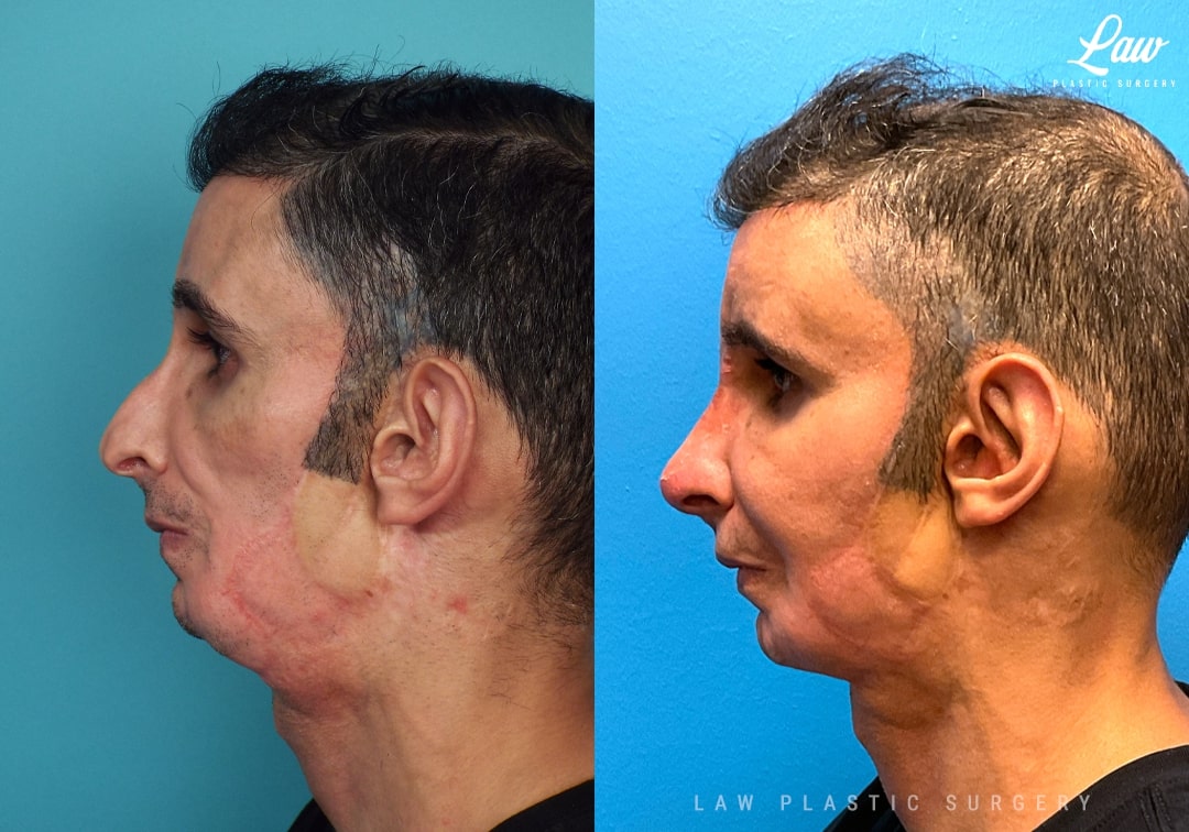 Parry Romberg Syndrome Before and After Photo. Surgery performed in Dallas, TX at Law Plastic Surgery.