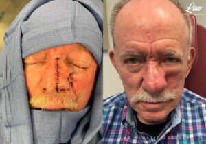 Skin Cancer Reconstruction Before and After Photo. Surgery performed in Dallas, TX at Law Plastic Surgery.