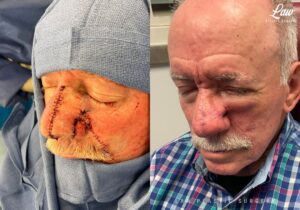 Skin Cancer Reconstruction Before and After Photo. Surgery performed in Dallas, TX at Law Plastic Surgery.
