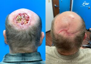 Skin Cancer Reconstruction Before and After Photo. Surgery performed in Dallas, TX at Law Plastic Surgery.