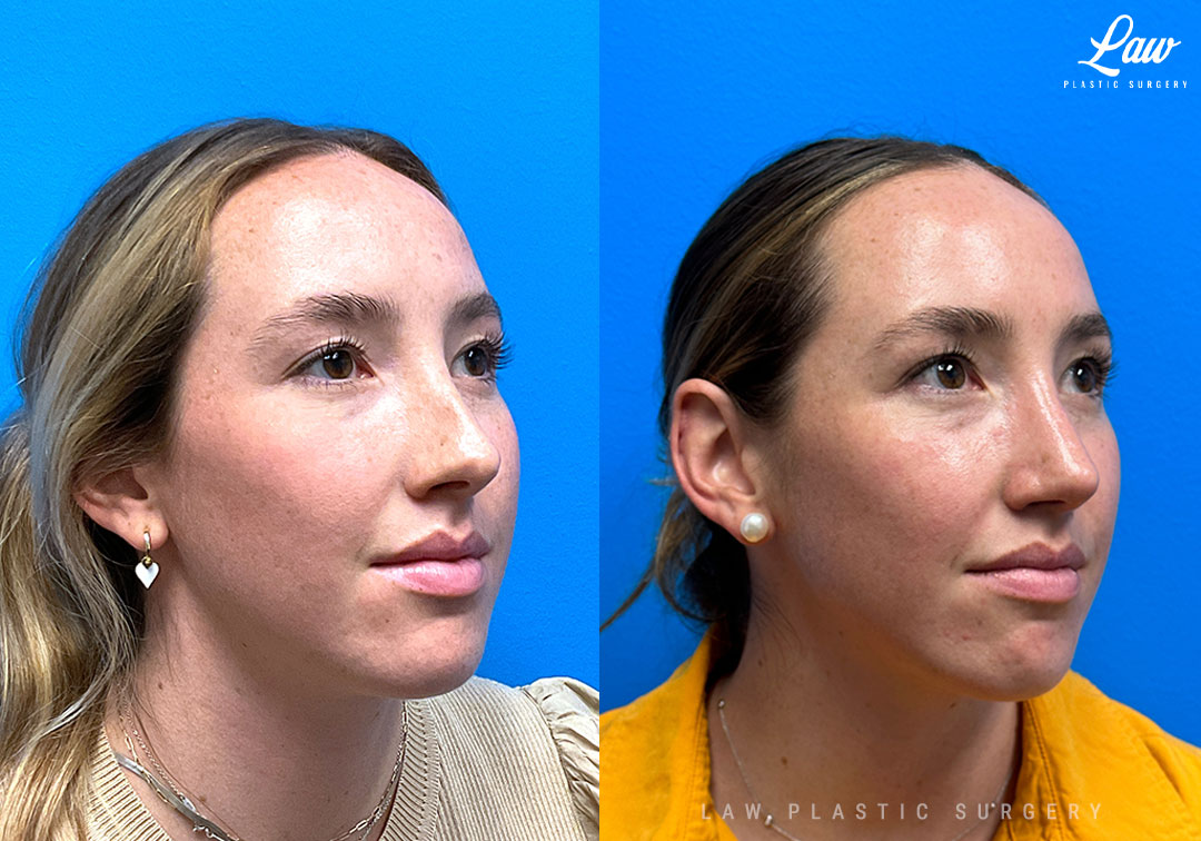 Rhinoplasty (Nose Job) Before & After Photo. Surgery performed in Dallas, TX at Law Plastic Surgery.