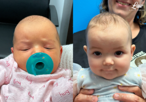 Craniosynostosis Before and After Photo. Surgery performed in Dallas, TX at Law Plastic Surgery.