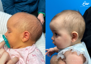 Craniosynostosis Before and After Photo. Surgery performed in Dallas, TX at Law Plastic Surgery.