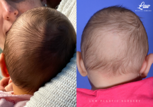 Craniosynostosis Before and After Photo. Surgery performed in Dallas, TX at Law Plastic Surgery.