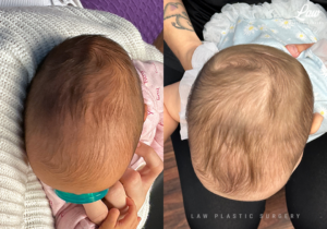 Craniosynostosis Before and After Photo. Surgery performed in Dallas, TX at Law Plastic Surgery.