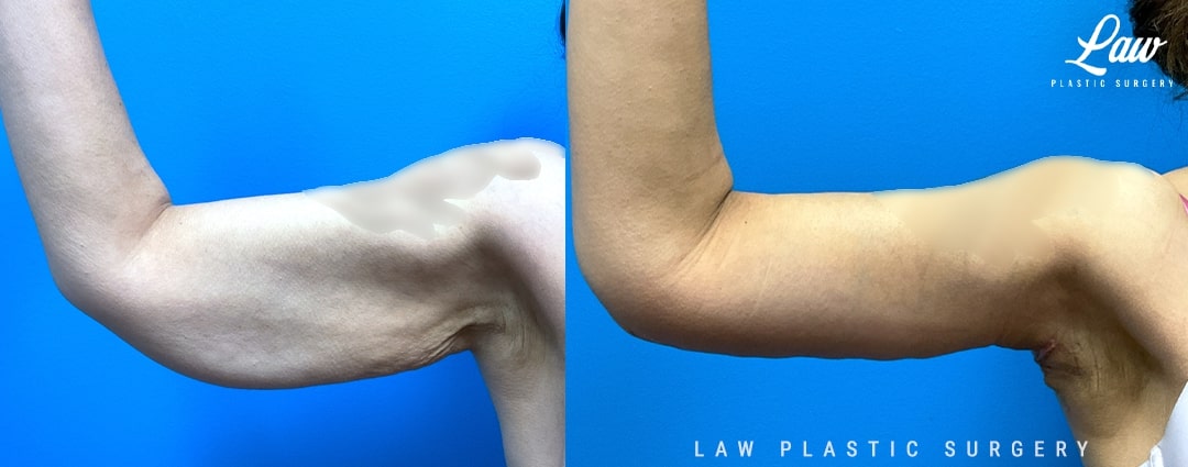 Arm Lift (Brachioplasty) Before & After Photo. Surgery performed in Dallas, TX at Law Plastic Surgery.
