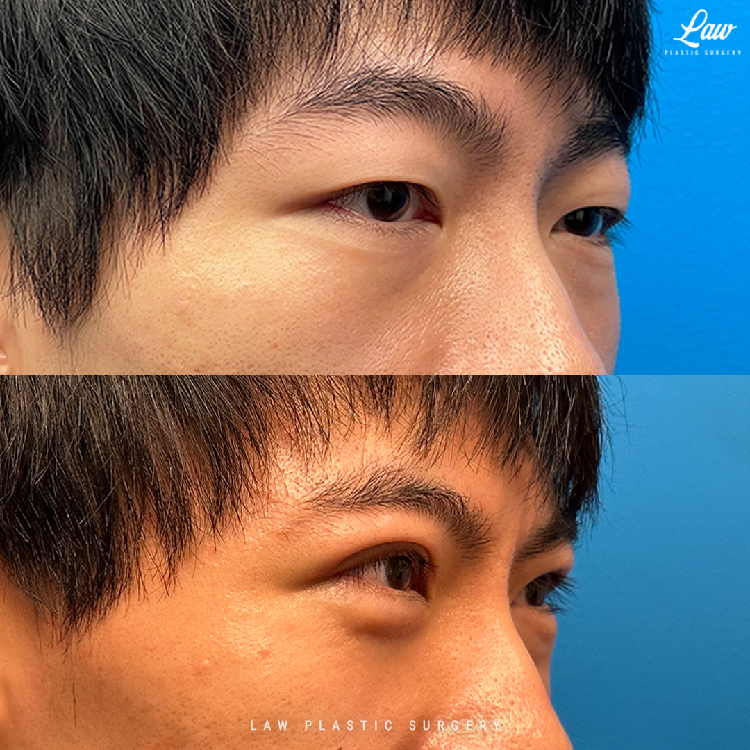 Asian Eyelid Surgery Before & After Photo. Surgery performed in Dallas, TX at Law Plastic Surgery.