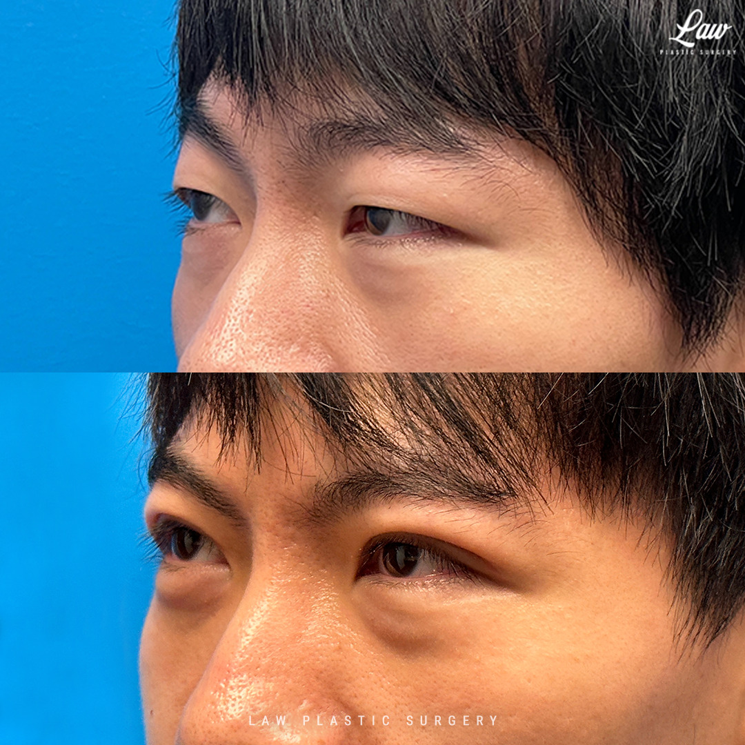 Asian Eyelid Surgery Before & After Photo. Surgery performed in Dallas, TX at Law Plastic Surgery.