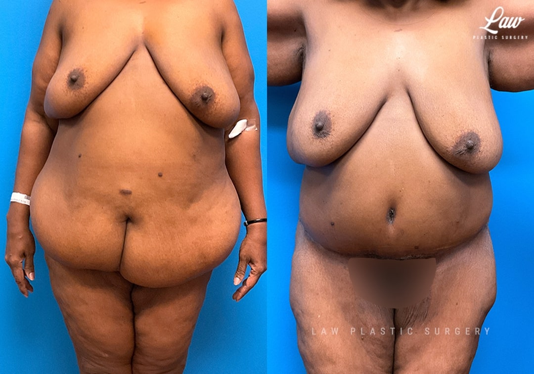 Back Lift Before & After Photo. Surgery performed in Dallas, TX at Law Plastic Surgery.