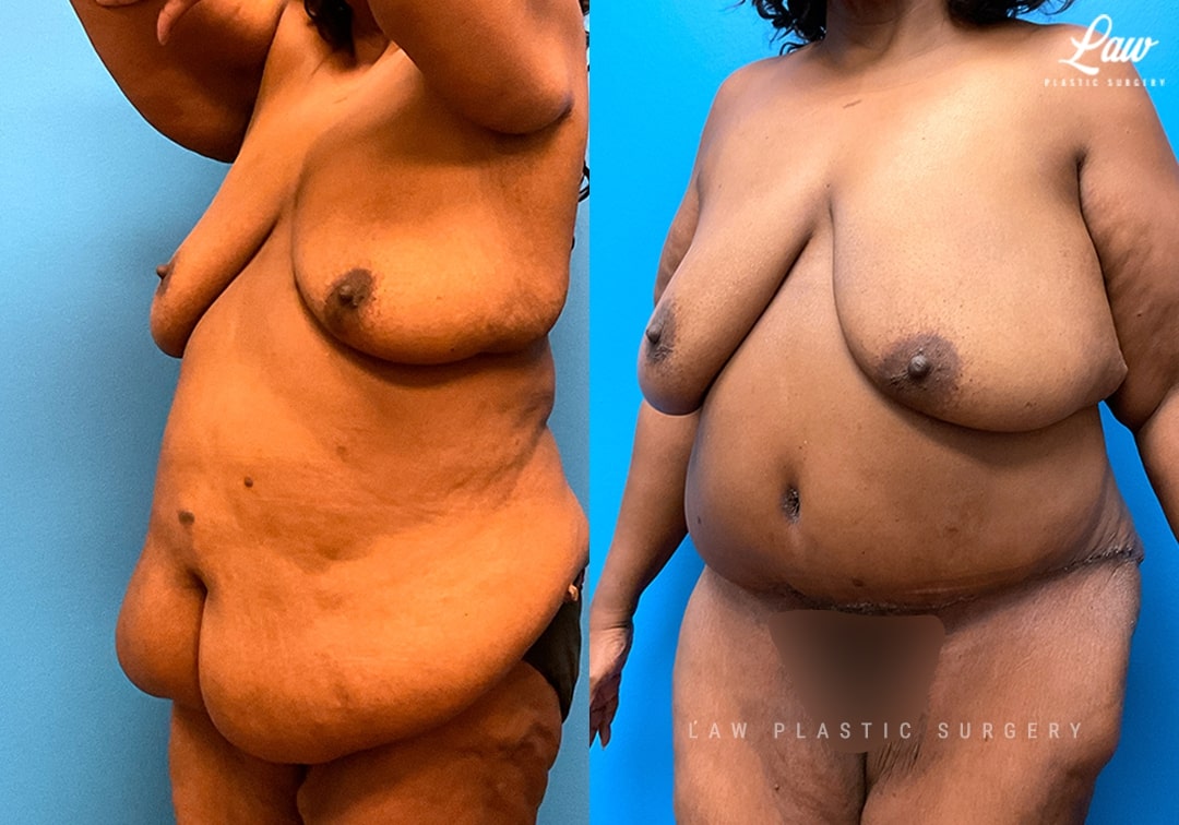 Back Lift Before & After Photo. Surgery performed in Dallas, TX at Law Plastic Surgery.
