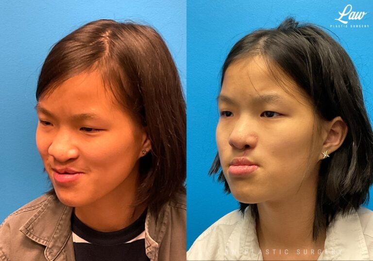 Cleft Lip Repair, Secondary and Adult Before & After Photos - Law ...