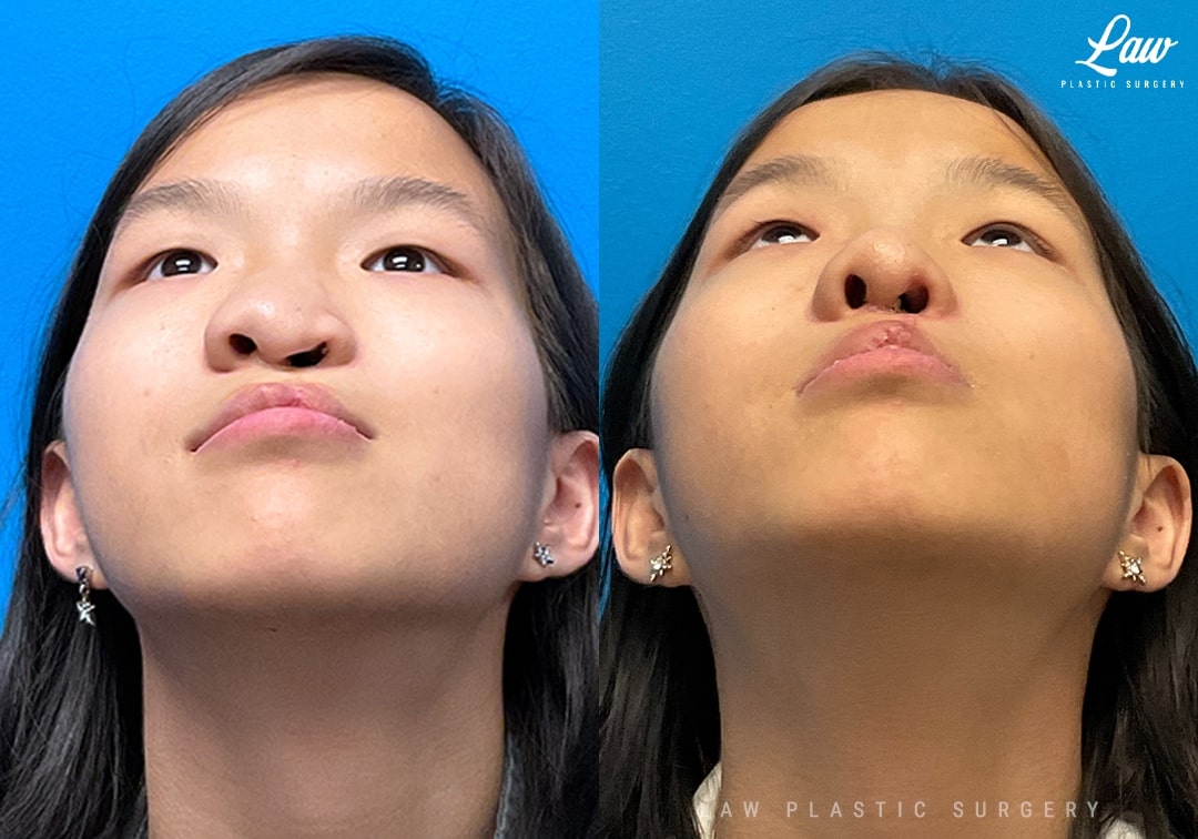 Cleft Lip Repair, Secondary and Adult Before & After Photo. Surgery performed in Dallas, TX at Law Plastic Surgery.