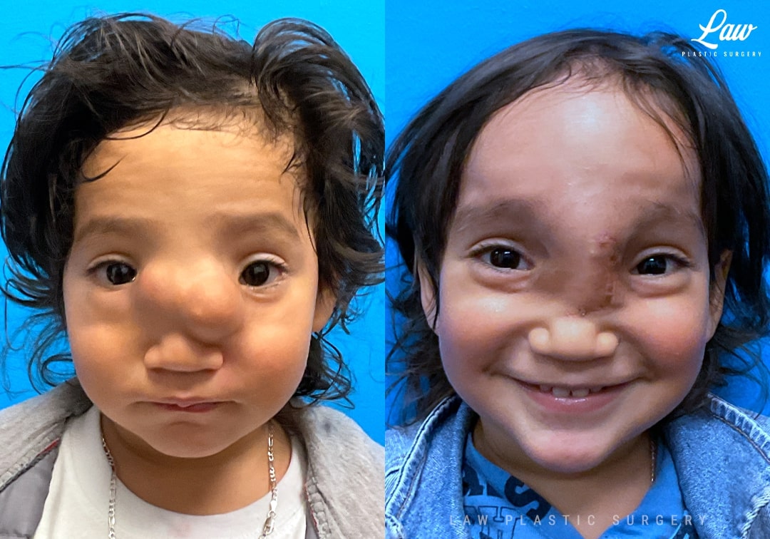 Craniofacial Reconstruction Before & After Photo. Surgery performed in Dallas, TX at Law Plastic Surgery.
