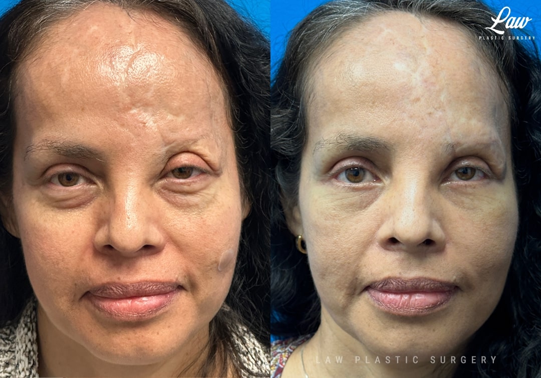 Craniofacial Reconstruction Before & After Photo. Surgery performed in Dallas, TX at Law Plastic Surgery.