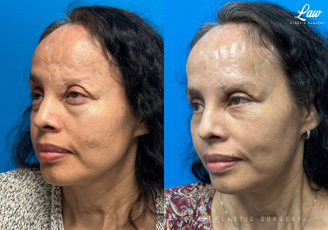 Craniofacial Reconstruction Before & After Photo. Surgery performed in Dallas, TX at Law Plastic Surgery.