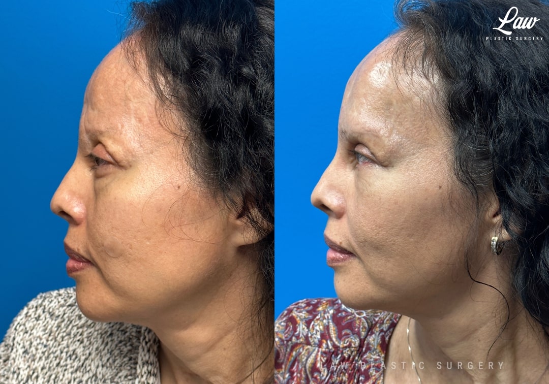 Craniofacial Reconstruction Before & After Photo. Surgery performed in Dallas, TX at Law Plastic Surgery.