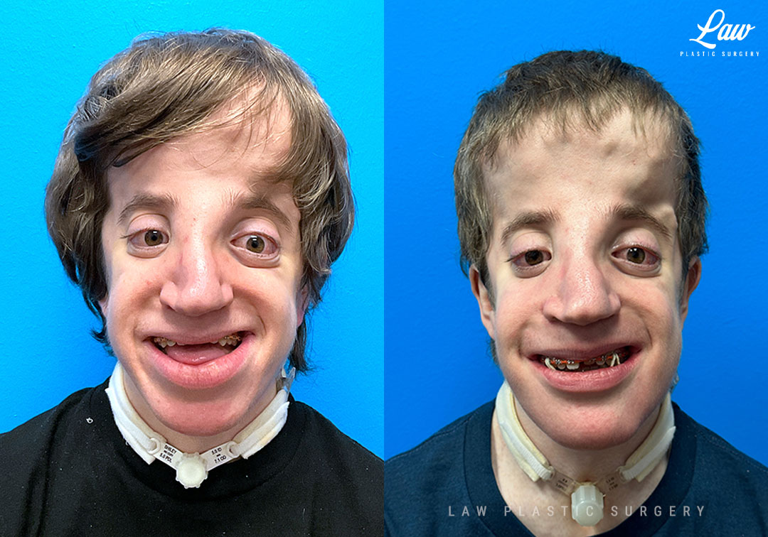 Craniofacial Reconstruction Before & After Photo. Surgery performed in Dallas, TX at Law Plastic Surgery.