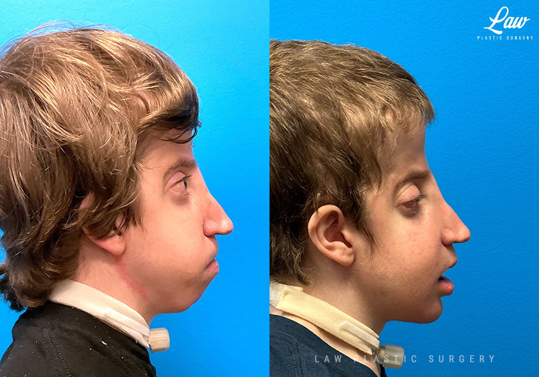 Craniofacial Reconstruction Before & After Photo. Surgery performed in Dallas, TX at Law Plastic Surgery.