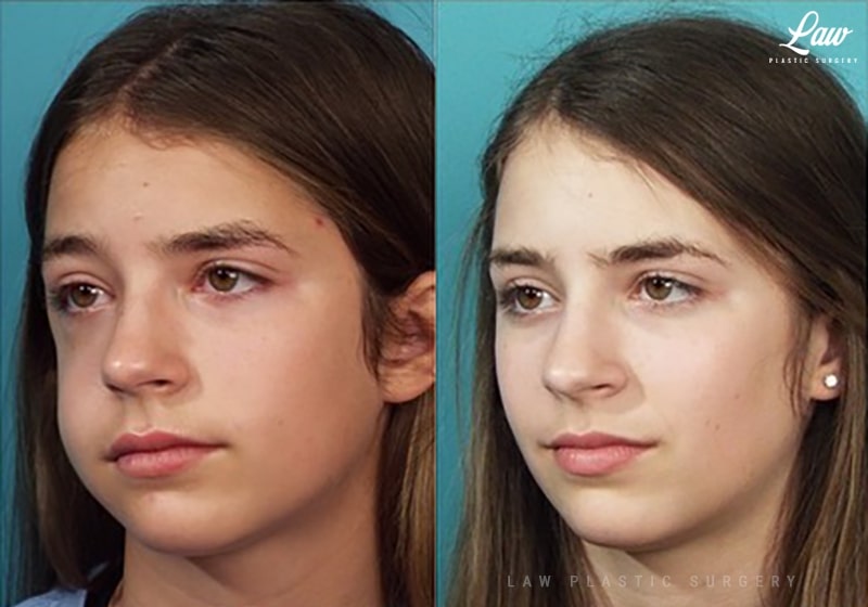 Facial Fracture and Lacerations Before & After Photo. Surgery performed in Dallas, TX at Law Plastic Surgery.