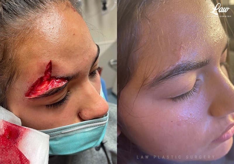 Facial Fracture and Lacerations Before & After Photo. Surgery performed in Dallas, TX at Law Plastic Surgery.