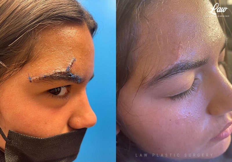 Facial Fracture and Lacerations Before & After Photo. Surgery performed in Dallas, TX at Law Plastic Surgery.