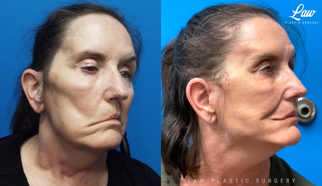 Facial Paralysis Surgery Before & After Photo. Surgery performed in Dallas, TX at Law Plastic Surgery.