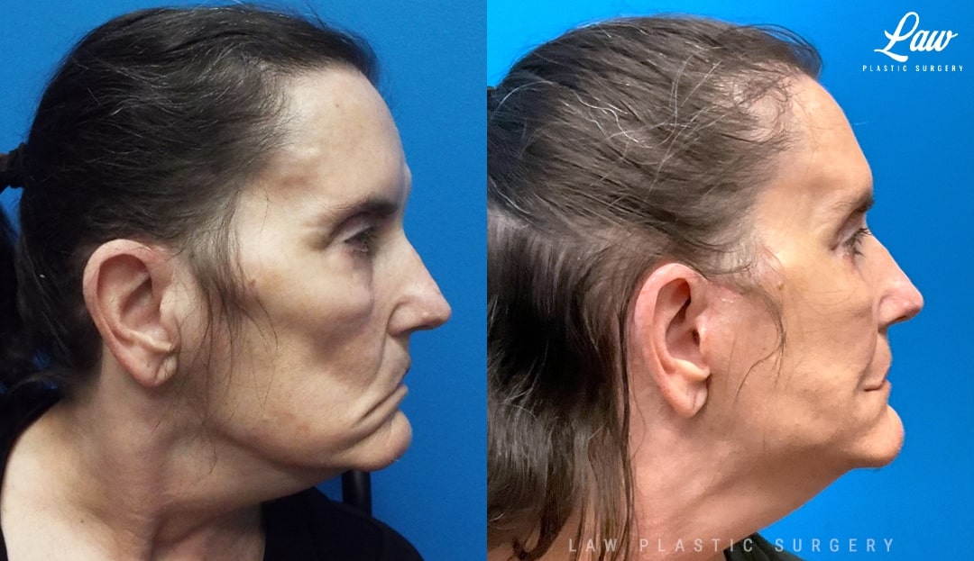 Facial Paralysis Surgery Before & After Photo. Surgery performed in Dallas, TX at Law Plastic Surgery.