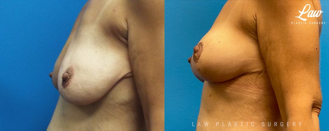 Fat Transfer Breast Augmentation Before & After Photo. Surgery performed in Dallas, TX at Law Plastic Surgery.