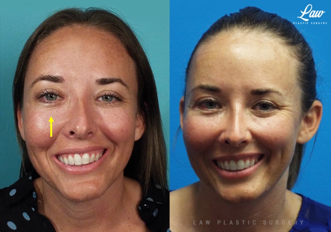 Fibrous Dysplasia Before & After Photo. Surgery performed in Dallas, TX at Law Plastic Surgery.