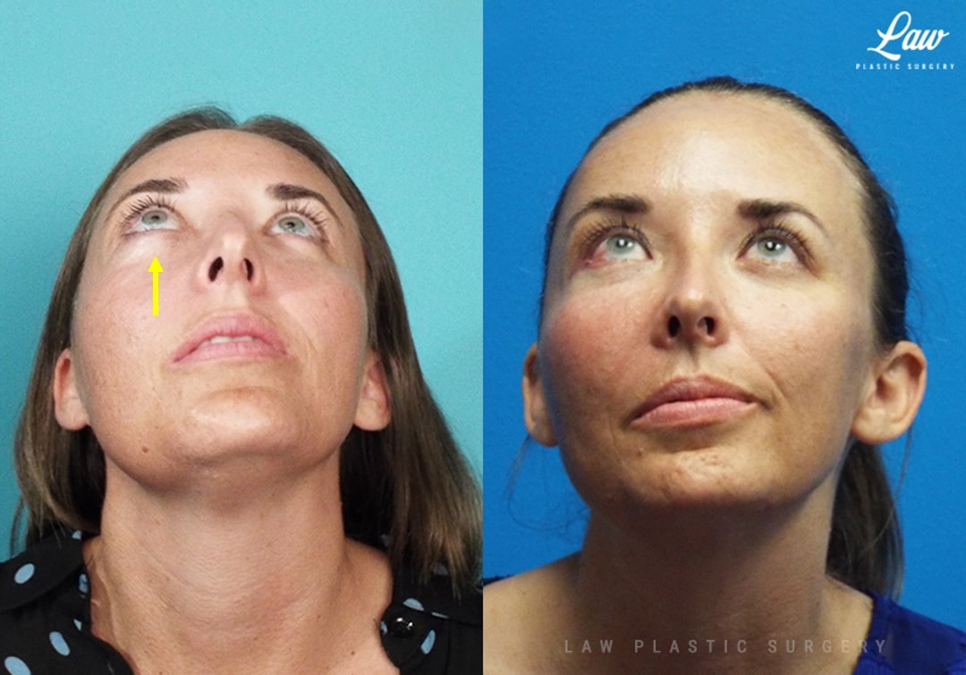 Fibrous Dysplasia Before & After Photo. Surgery performed in Dallas, TX at Law Plastic Surgery.