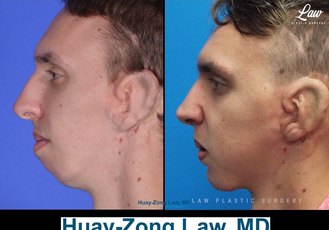 Hemifacial Microsomia / Goldenhar Syndrome Before & After Photo. Surgery performed in Dallas, TX at Law Plastic Surgery.