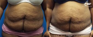 Panniculectomy Before & After Photo. Surgery performed in Dallas, TX at Law Plastic Surgery.