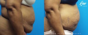 Panniculectomy Before & After Photo. Surgery performed in Dallas, TX at Law Plastic Surgery.