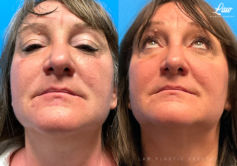 Scar Revision Before and After Photo. Surgery performed in Dallas, TX at Law Plastic Surgery.