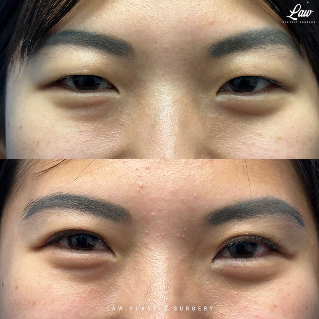 Asian Eyelid Surgery Before & After Photo. Surgery performed in Dallas, TX at Law Plastic Surgery.