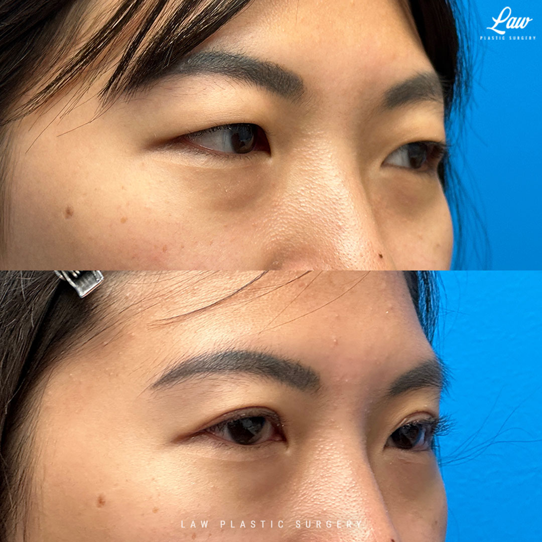 Asian Eyelid Surgery Before & After Photo. Surgery performed in Dallas, TX at Law Plastic Surgery.