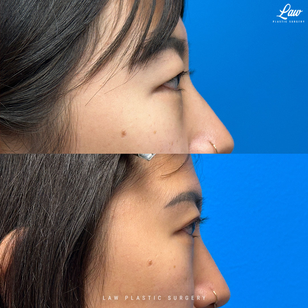 Asian Eyelid Surgery Before & After Photo. Surgery performed in Dallas, TX at Law Plastic Surgery.