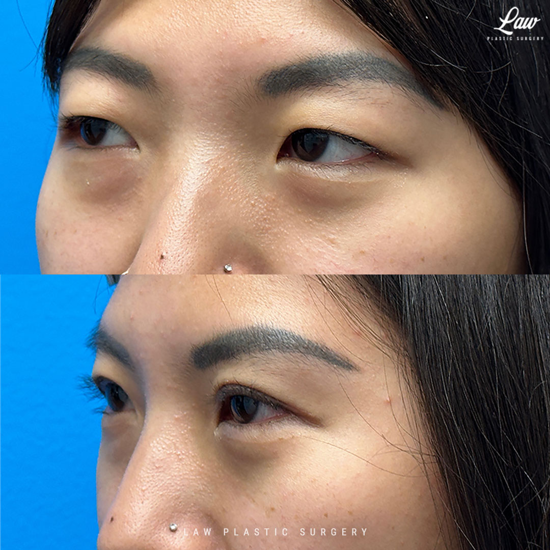 Asian Eyelid Surgery Before & After Photo. Surgery performed in Dallas, TX at Law Plastic Surgery.