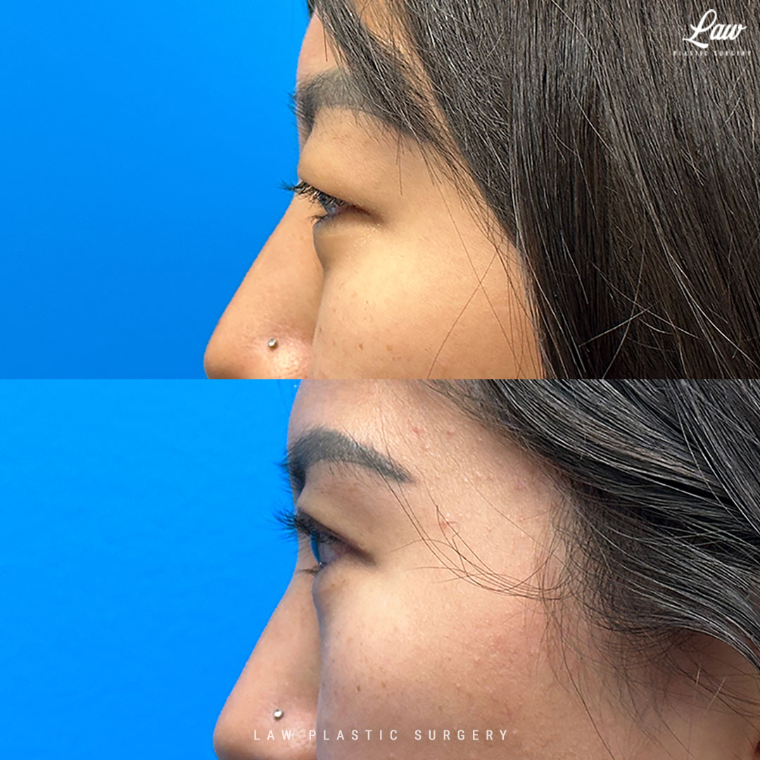 Asian Eyelid Surgery Before & After Photo. Surgery performed in Dallas, TX at Law Plastic Surgery.