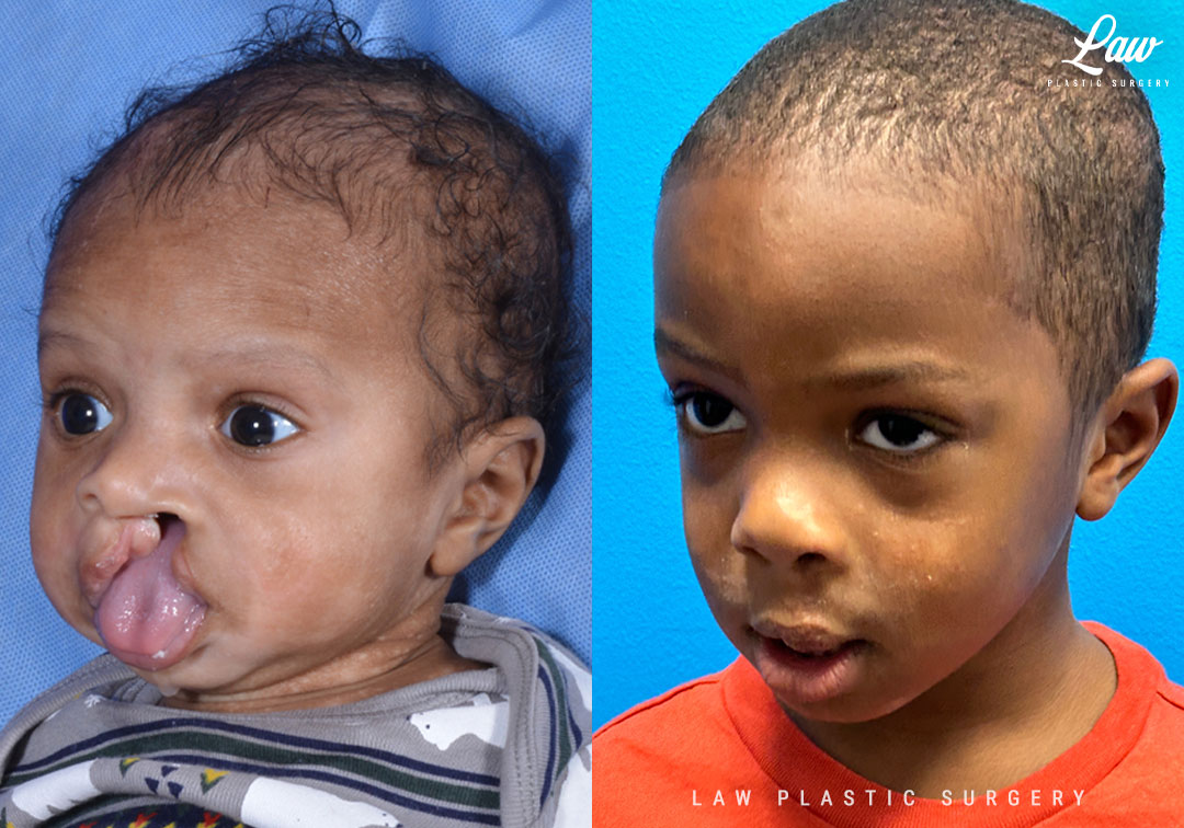 Cleft Lip Repair Before & After Photo. Surgery performed in Dallas, TX at Law Plastic Surgery.