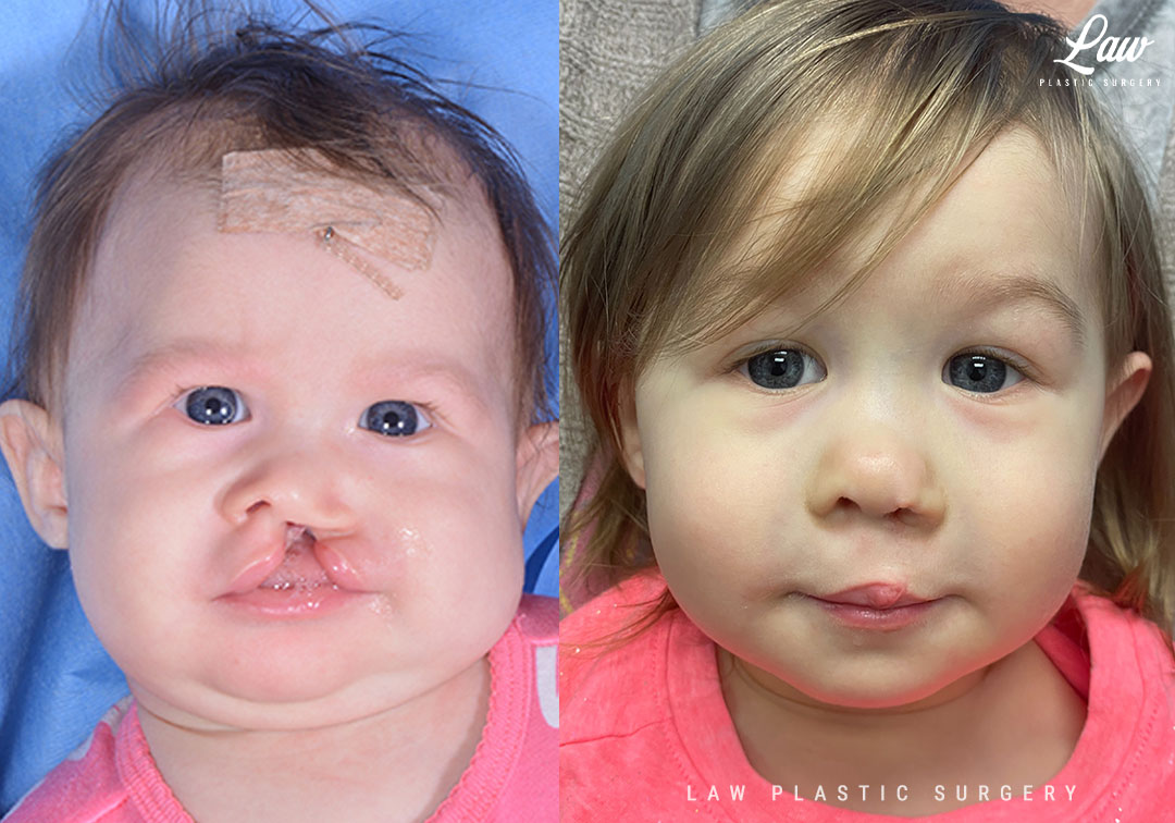 Cleft Lip Repair Before & After Photo. Surgery performed in Dallas, TX at Law Plastic Surgery.