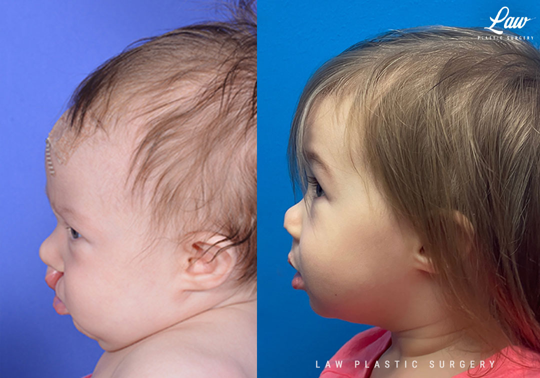 Cleft Lip Repair Before & After Photo. Surgery performed in Dallas, TX at Law Plastic Surgery.