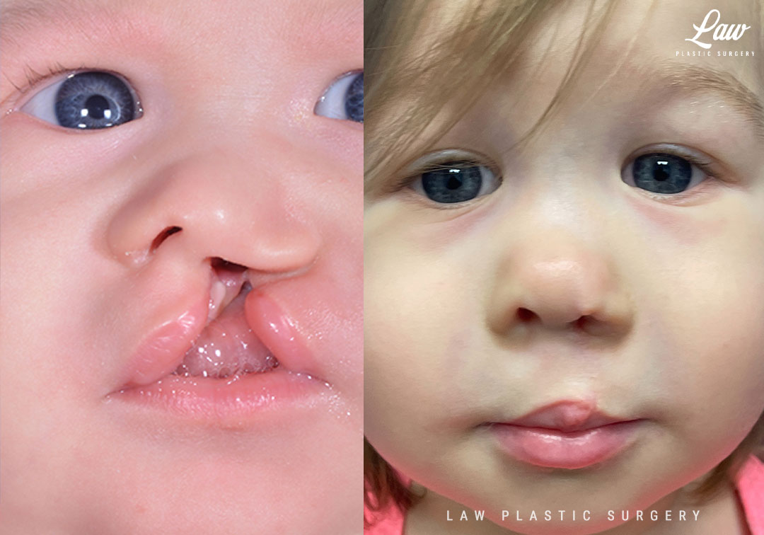 Cleft Lip Repair Before & After Photo. Surgery performed in Dallas, TX at Law Plastic Surgery.