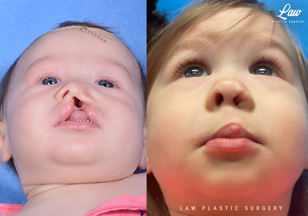 Cleft Lip Repair Before & After Photo. Surgery performed in Dallas, TX at Law Plastic Surgery.