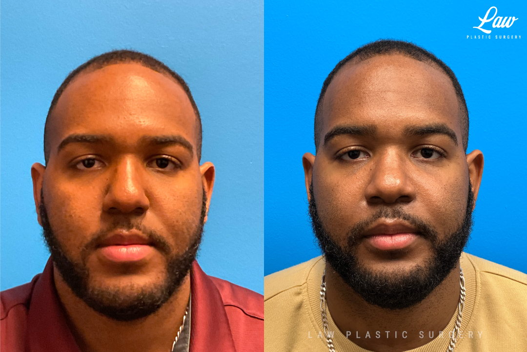 Jaw Surgery Before and After Photo. Surgery performed in Dallas, TX at Law Plastic Surgery.