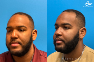 Jaw Surgery Before and After Photo. Surgery performed in Dallas, TX at Law Plastic Surgery.